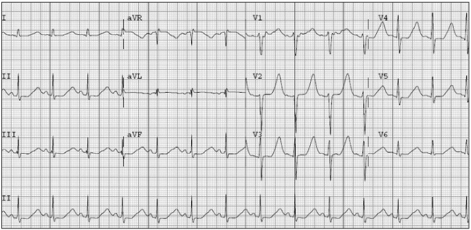 低血钾的心电图波形图片