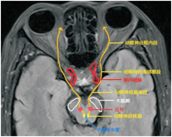 眼肌ct解剖图片