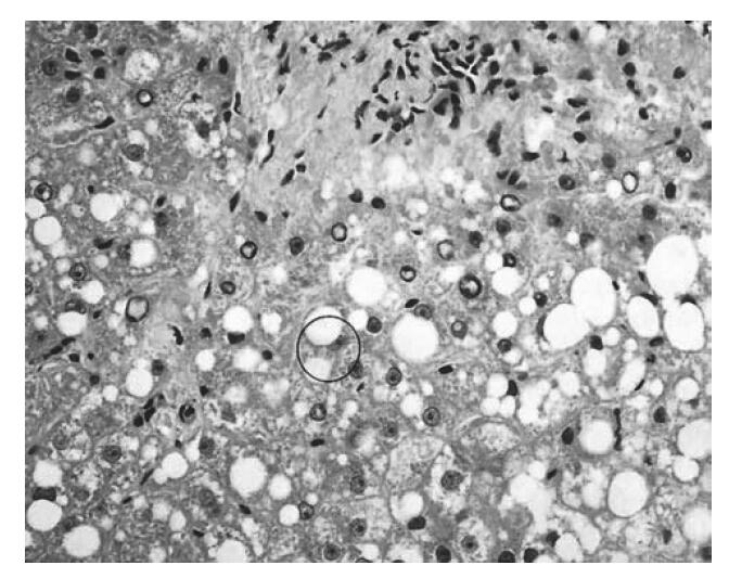 枯否细胞增大,有些患者见到特征性mallory小体,类似急性酒精性肝炎,还