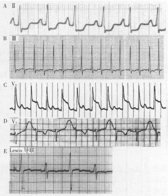 2 qrs波群交替 qrs波群时程交替常见于间歇性预激综合征和间歇性束支