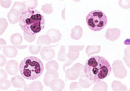 左上:m2a细胞胞质中auer小体较粗;左下:m3细胞胞质中成捆状auer小体