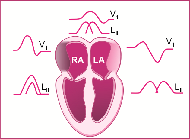 管你有多少种"异常p波",一文都搞定 |轻松解读心电图