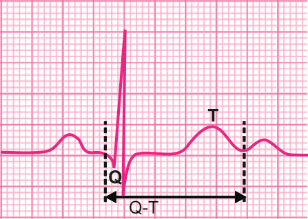 qt间期异常知多少轻松解读心电图
