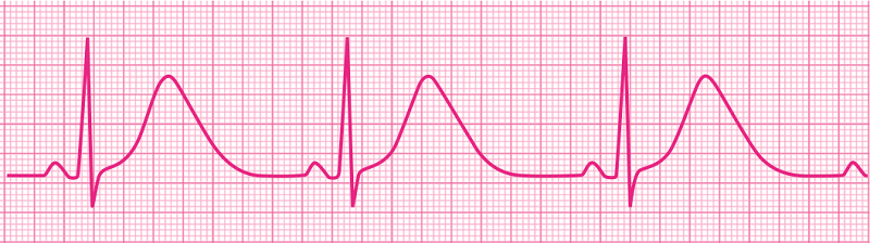 qt间期异常知多少轻松解读心电图