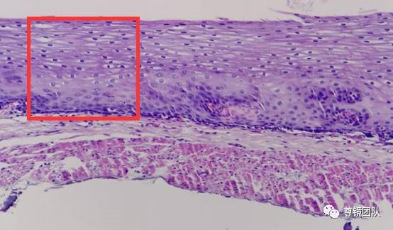 早癌诊断基础食管黏膜层微血管结构表现