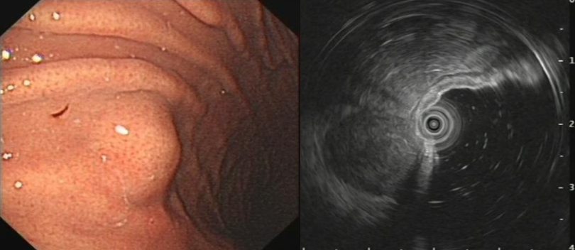 一文读懂 | 内镜下胃肠道间质瘤的治疗