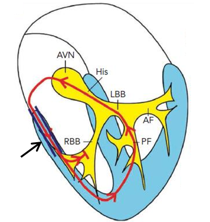 mahaim束为右室游离壁的旁路,只有前传功能(箭头所示)