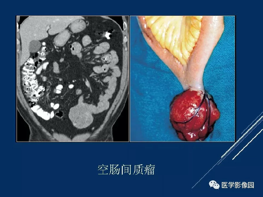 15个病例熟悉胃肠道间质瘤影像表现