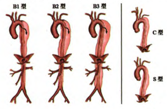 主动脉夹层分型示意图图片