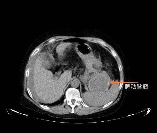 脾动脉瘤超声图片图片