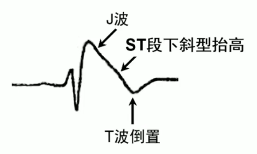 心电图brugada波样改变图片