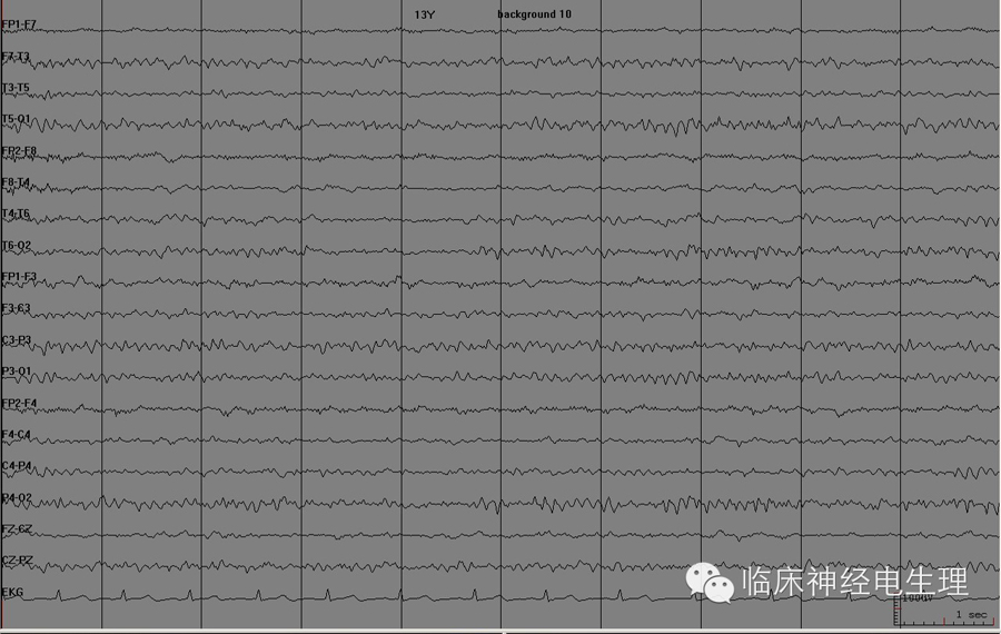 临床基础:一文读懂脑电图的α节律
