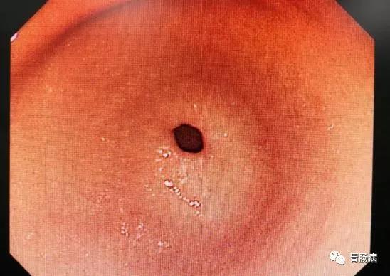 胃窦正常胃镜显示图片图片
