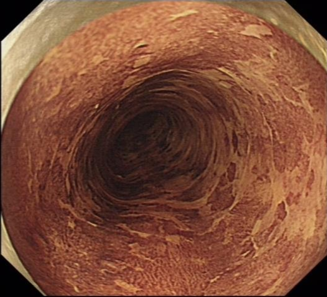 早期食管癌(图谱)集锦