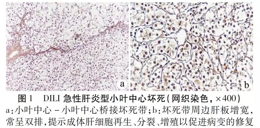 膽汁淤積輕者,需要在高倍鏡下仔細尋找才能發現肝細胞淤膽及毛細膽管