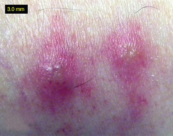 和蚊子大战300回合后,它叫来了"友军"