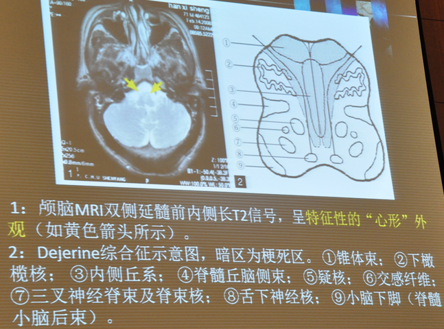 何志义:少见脑梗死的诊断和鉴别诊断|csa&tisc2018