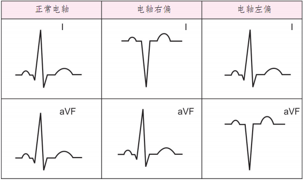 純乾貨,系統解讀心電圖的9個步驟 |心電圖學習一日通