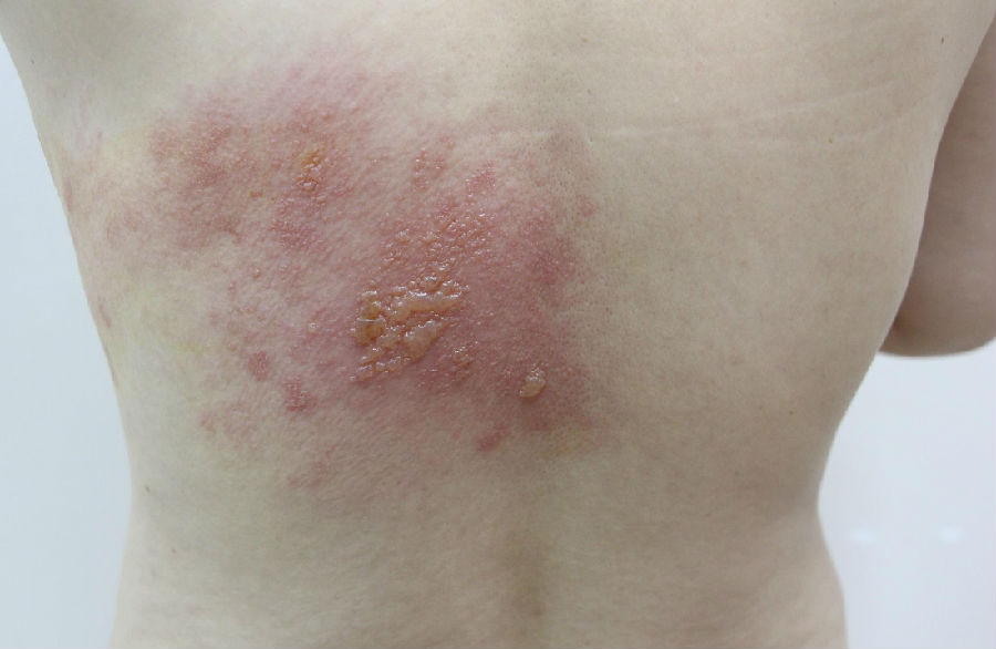 背部带状疱疹早期图片图片