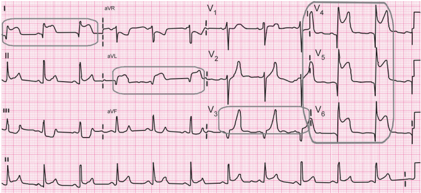 图11 心电图举例: 前间壁心肌梗死时,Ⅰ,avl,v3