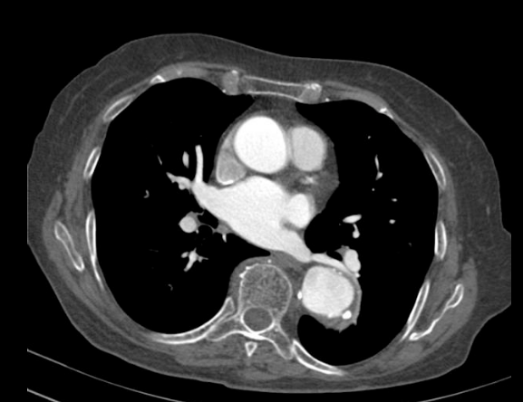 主动脉夹层钙化斑内移影像(增强ct)