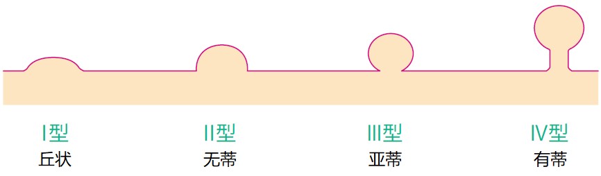 胃息肉山田分型图片图片