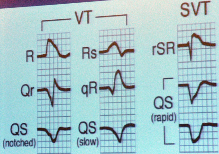 vereckei avr单导联分析法