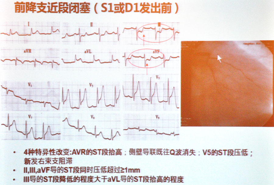 楊偉賢教授如何利用心電圖定位診斷冠心病心肌缺血