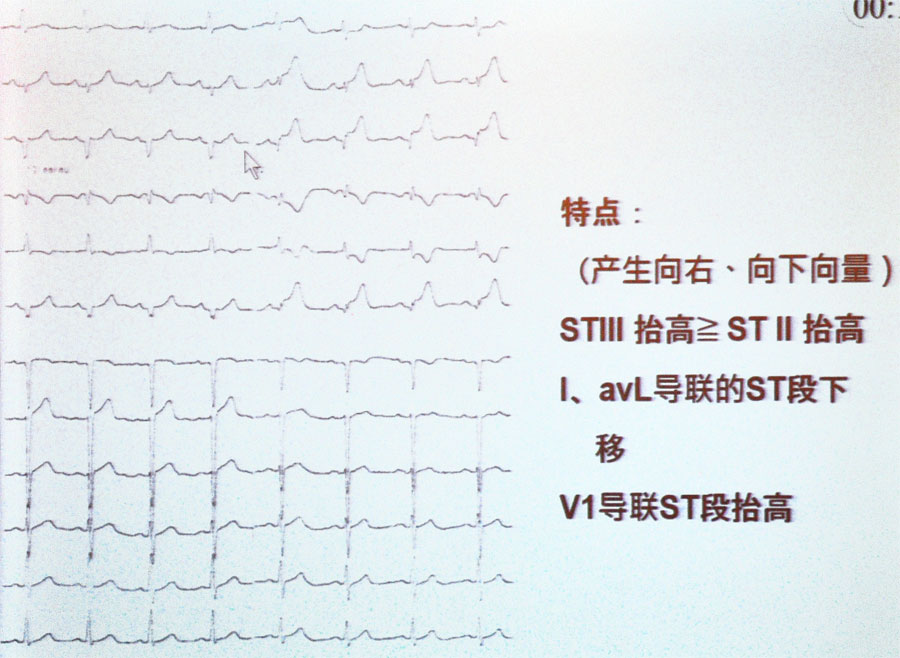 楊偉賢教授如何利用心電圖定位診斷冠心病心肌缺血