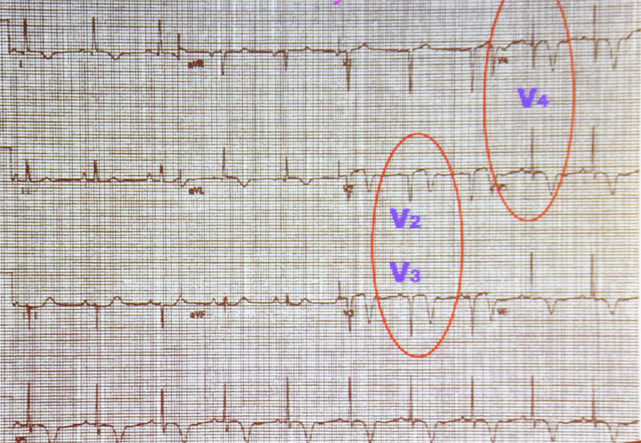 是指以胸前导联t波特征性改变,伴有冠状动脉左前降支近端严重狭窄的