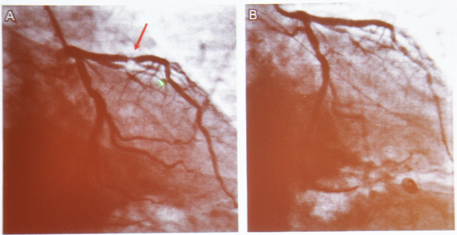 冠脉造影证实lad近段次全闭塞(a:支架植入前;b支架植入后)