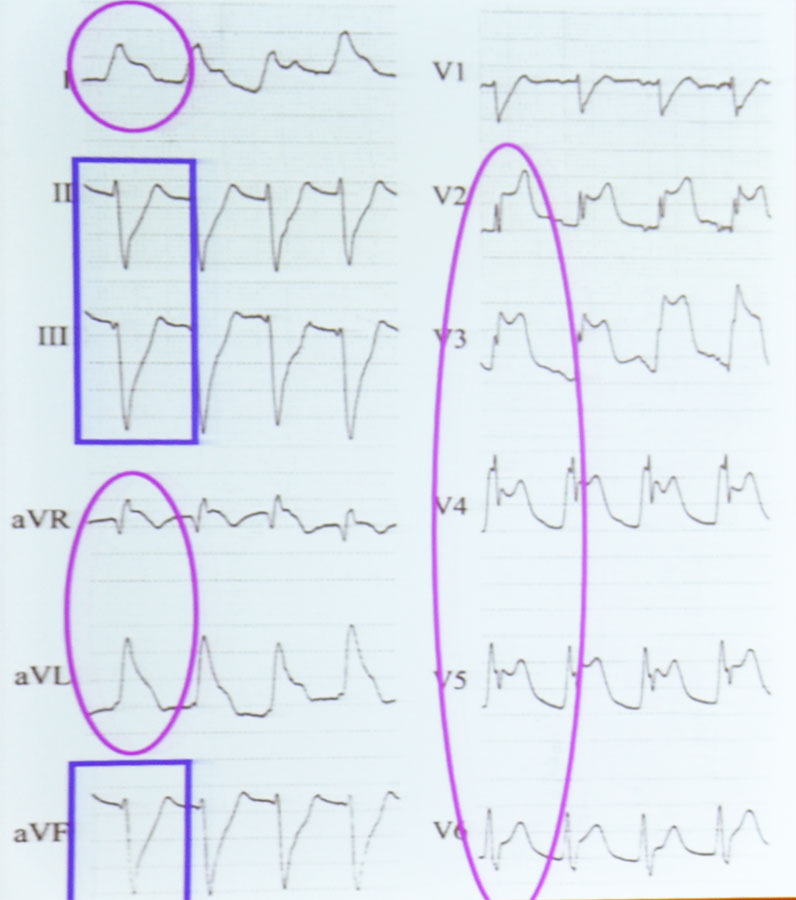 图15  8个st段抬高 3个st段压低