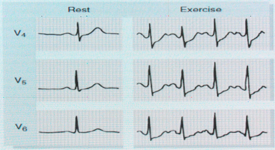平板运动试验心电图图片