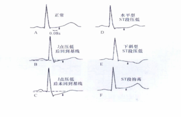 平板运动试验心电图图片