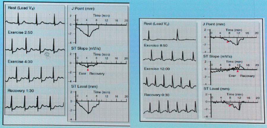平板运动试验心电图图片