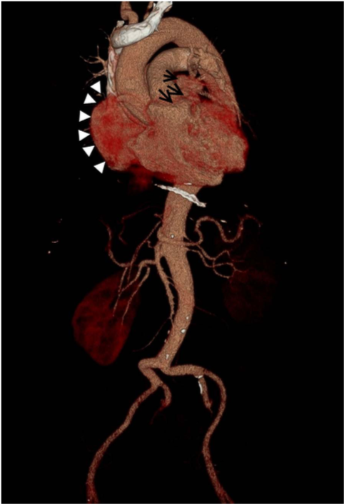 看了那么多心梗病例,我被这个冠脉造影惊掉了下巴