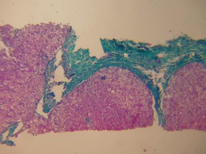 masson染色 由于肝穿标本的局限,虽然看不到整个肝小叶被纤维化