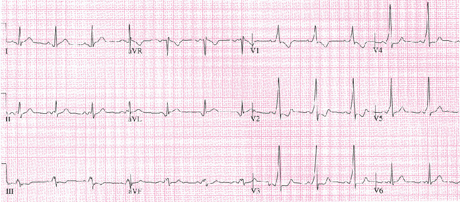 一文总结:预激综合征的心电图特点和诊治