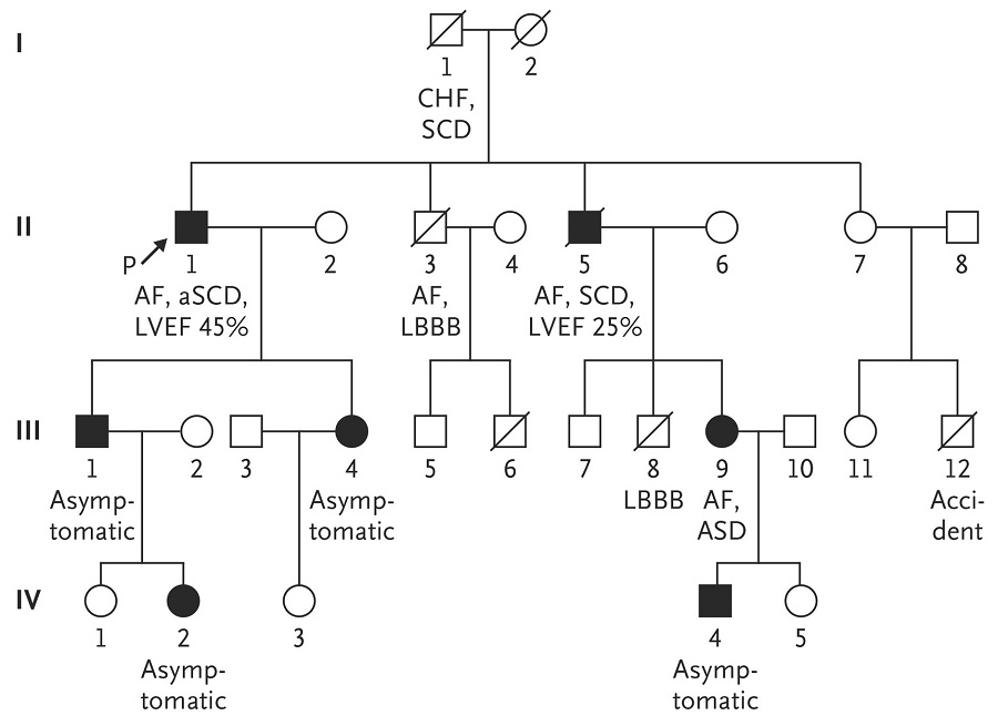 先证者家系图,三代共7人出现st段压低心电图表现,其中3人出现房颤