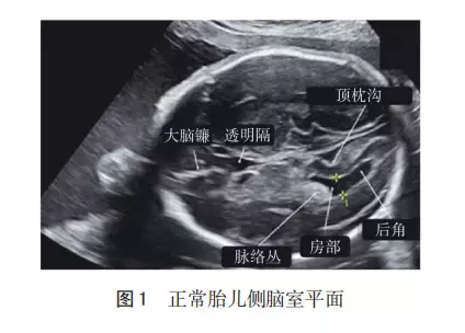 胎儿侧脑室增宽图片