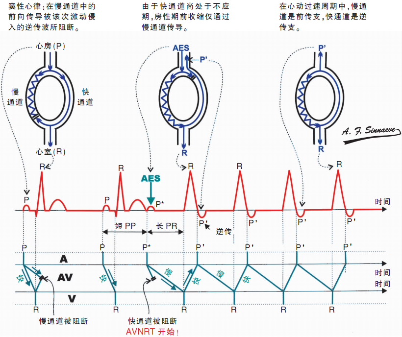 房室结折返性心动过速(avnrt) 常见类型是"慢-快"型.