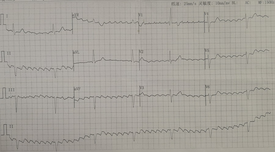 老陈房扑发作时的心电图,可见明显的f波,心室率40次/分左右