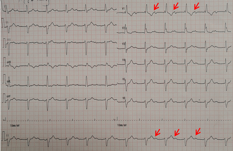 老陈窦律时的心电图,红色箭头指示p波,可见存在明显的一度房室