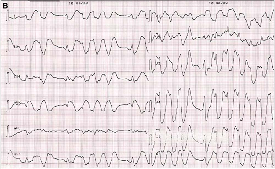 患者第二次晕厥时的心电图,提示为室颤