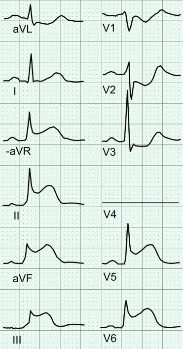 换个姿势来看心电图打开一个全新的视角