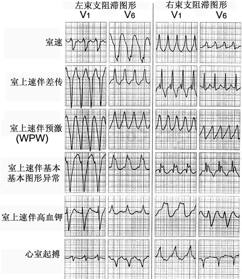 图1  常见的几种宽qrs波心动过速