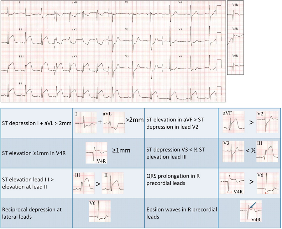 心電圖中iii導聯的st段抬高大於ii導聯; (2)v3r,v4r,v5r或v6r任一個或