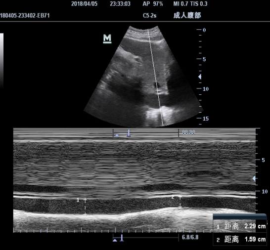 下腔静脉滤器超声图片