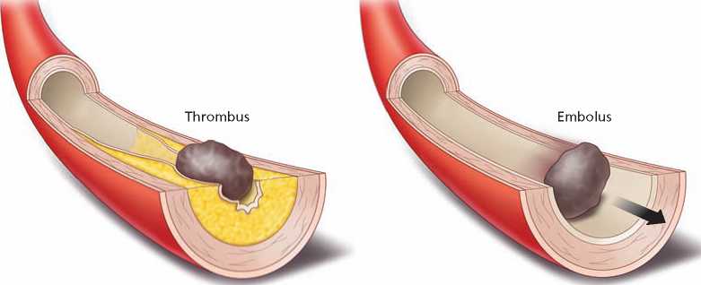 冠脉栓塞的示意图(右)