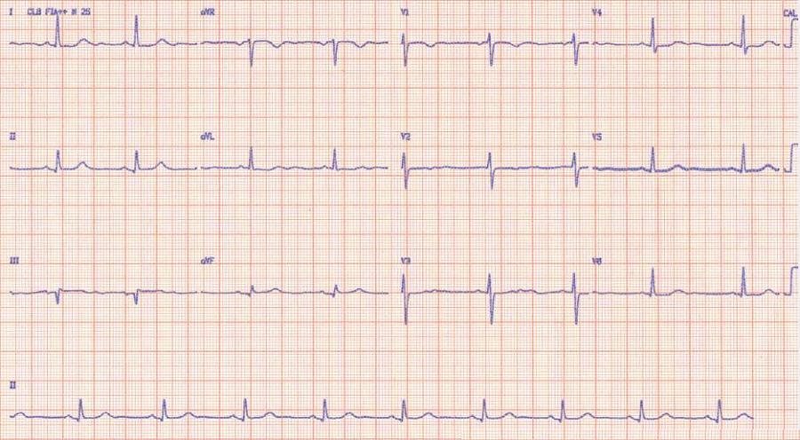 尸检明确原因|急诊"心"事_心源性休克_心肌梗死_医脉通